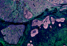 Fibromi o sarcomi? La radiomica per immagini aiuta la diagnosi