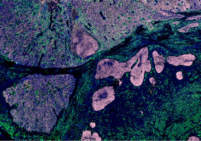 Fibromi o sarcomi? La radiomica per immagini aiuta la diagnosi