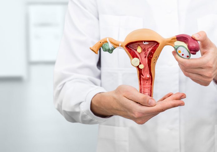 Polipi dell’endometrio: cosa sono e come trattarli